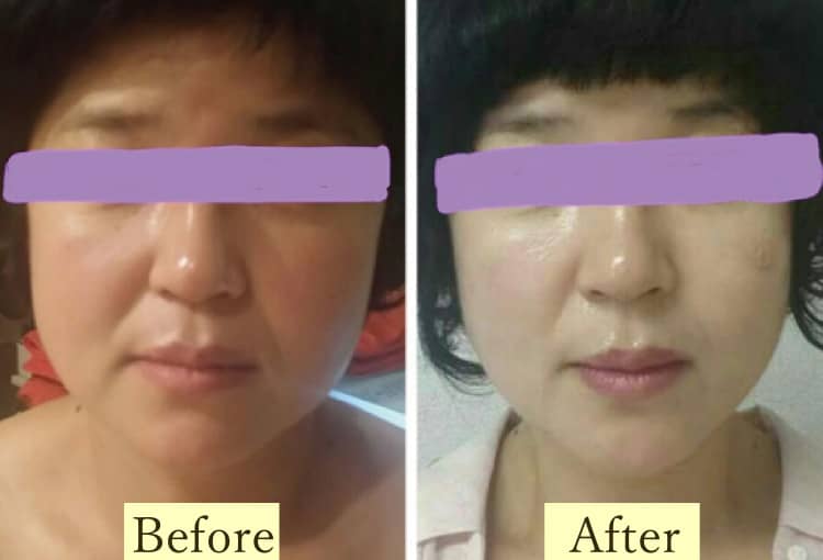 ④Sagging Lift-up Care